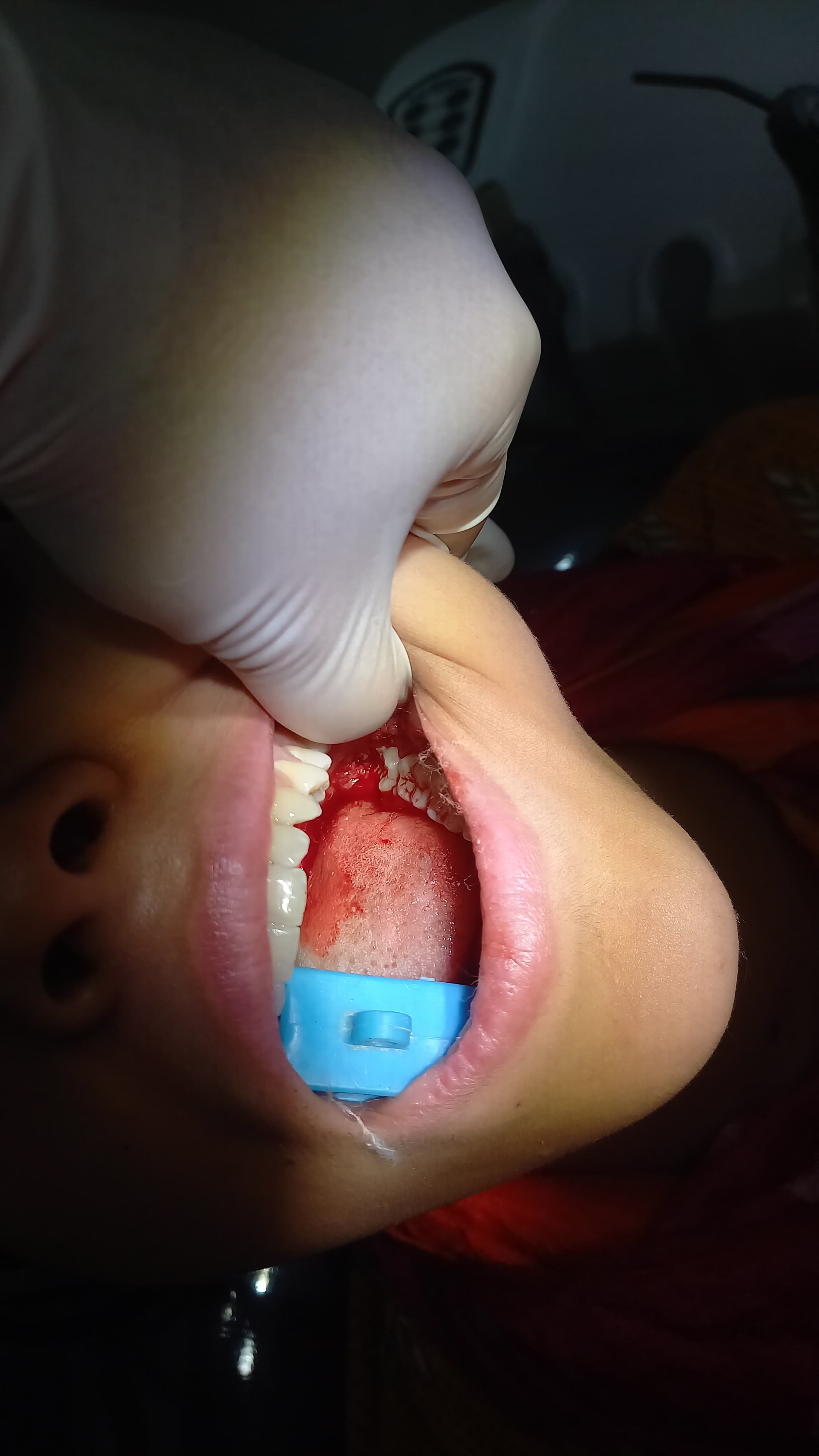 Before Treatment