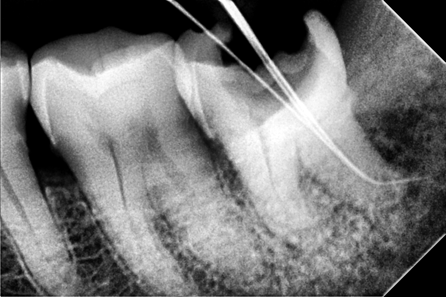 Before Treatment