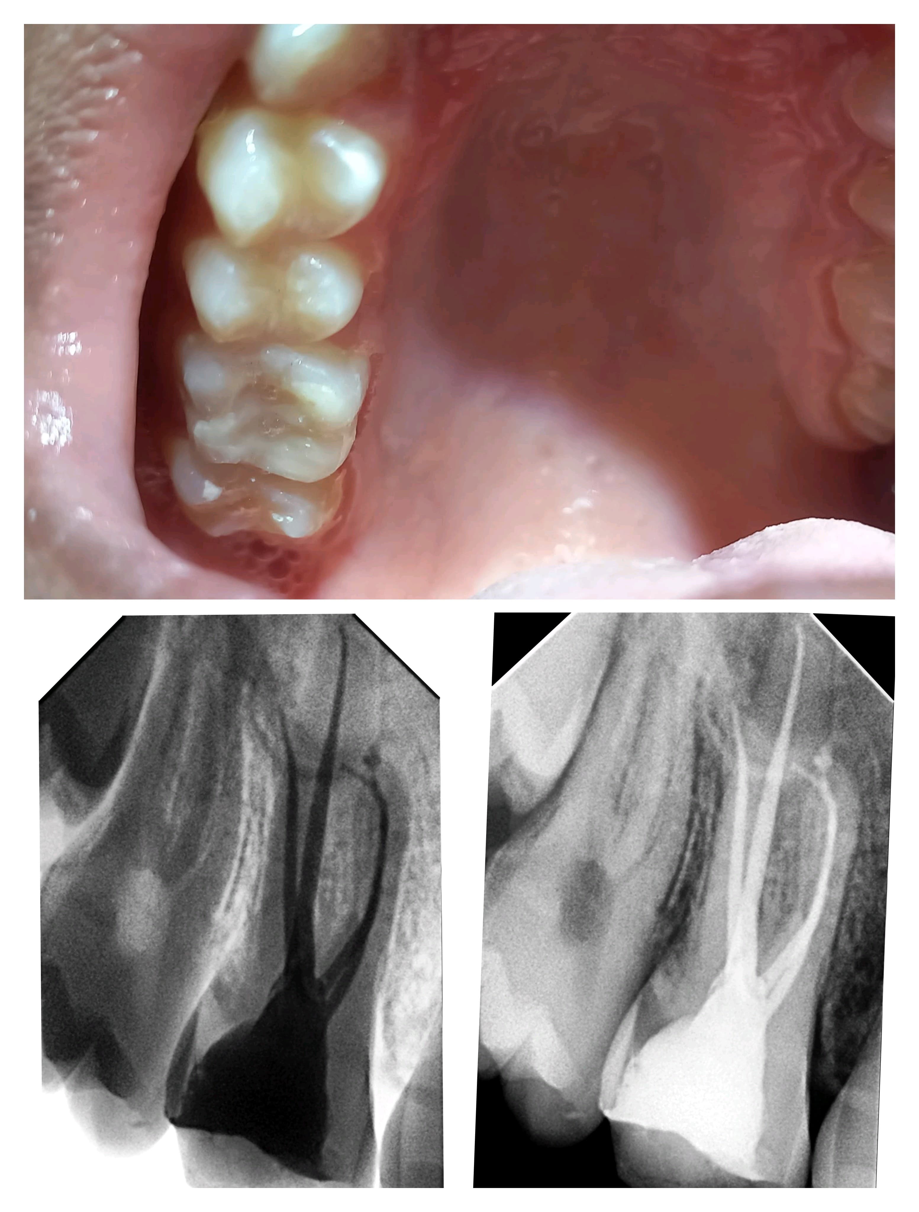 After Treatment