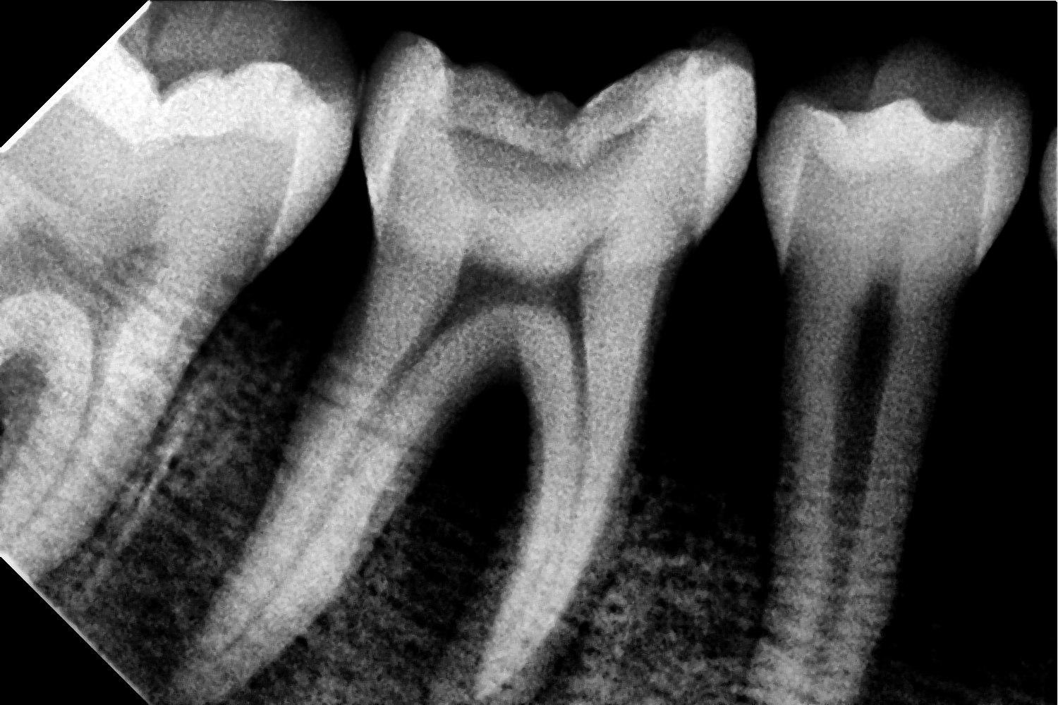 Before Treatment