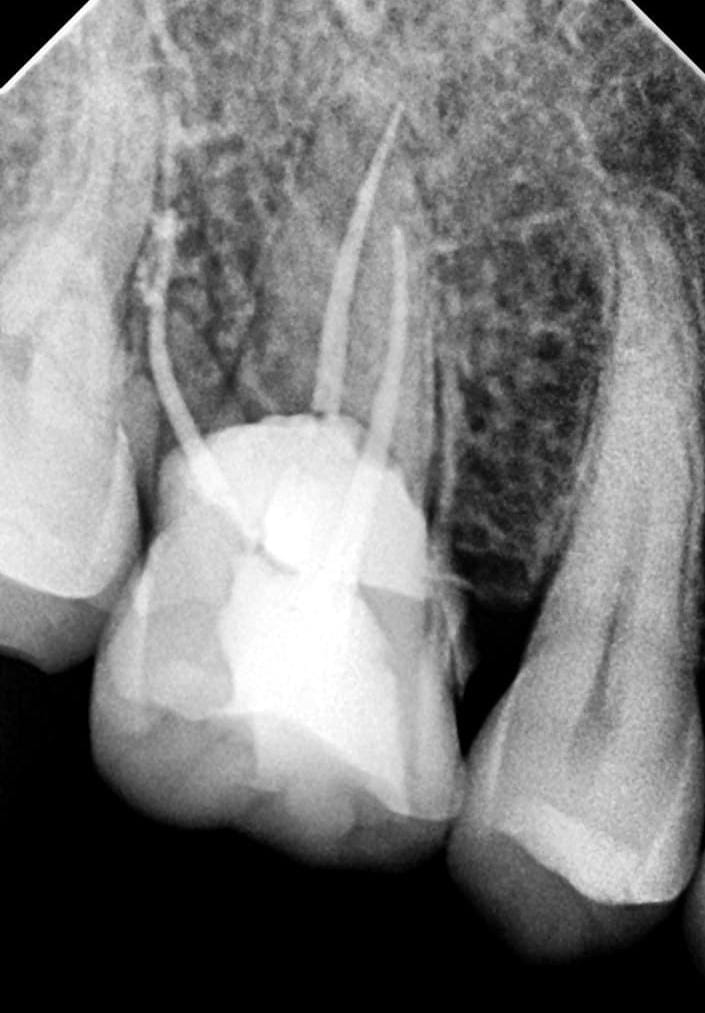 After Treatment