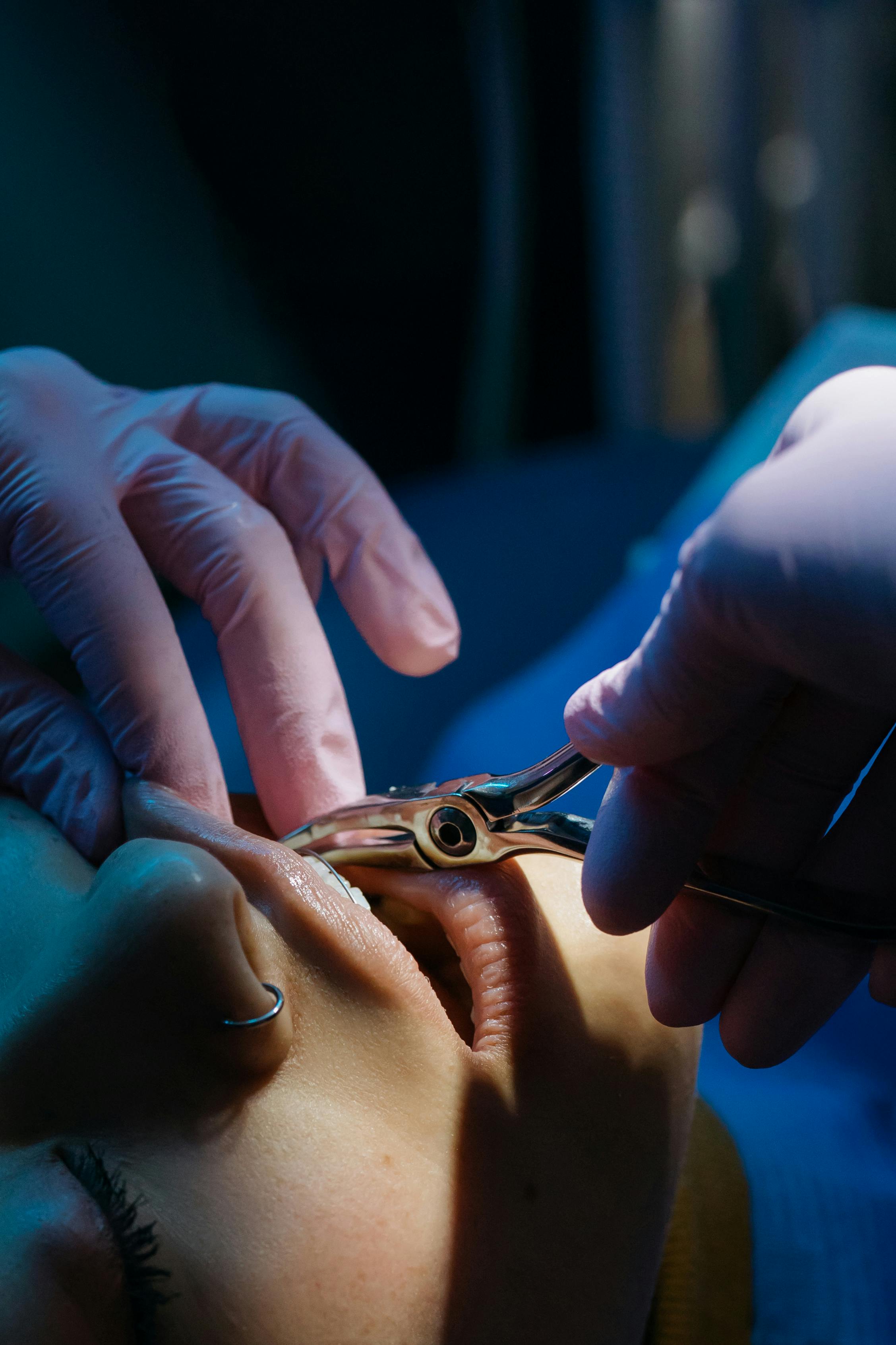 Tooth Extraction